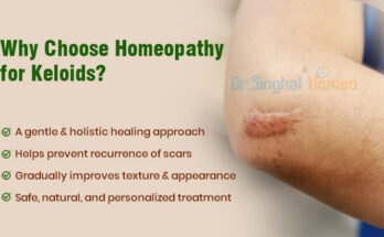 treatment for keloids in homeopathy