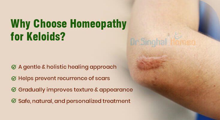 treatment for keloids in homeopathy